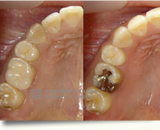 セラミックインレーの施術後
